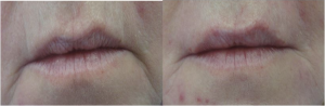 smokers line dermal filler Cheshire