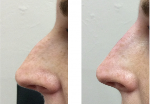 Nose reshaping correction dermal filler Cheshire